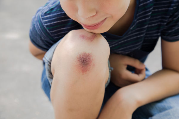 Closeup of injured young kid's knee after he fell down on pavement
