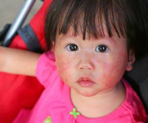 baby skin rash