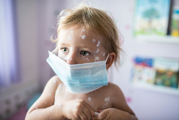girl with chicken pox in quarantine
