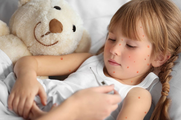 measuring temperature of girl with chicken pox